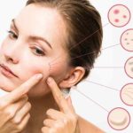 Acne treatment options