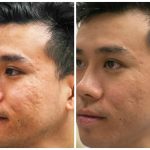 Acne laser mumbai scars dermatologist